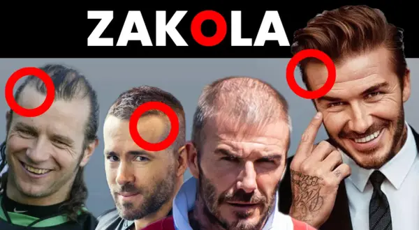 Czterech mężczyzn z widocznymi zakolami. Na zdjęciu widać różne fryzury na rzadkie włosy i zakola, z czerwonymi kółkami zaznaczonymi na ich głowach.
